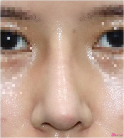 코끝연골재수술 코원성형외과 두 달 후기 사진 2
