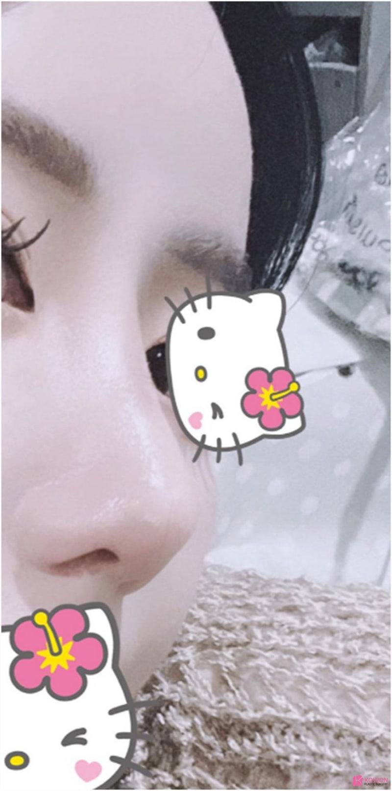 오똑한코 후기 화려한 모양 코필러녹음 방법 특징 사진 8