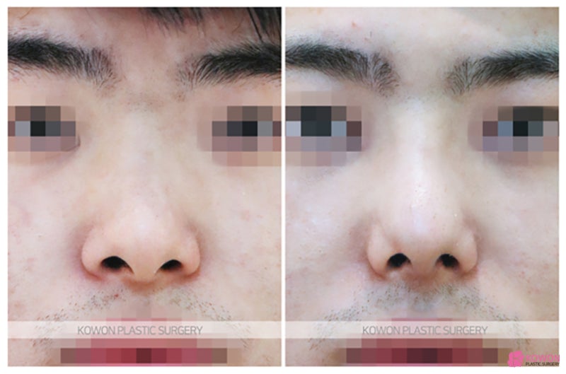 비중격만곡증성형 비염코휨 설명 교정 비대칭 비염 사진 5