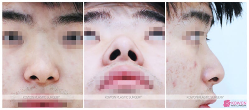 비중격만곡증성형 비염코휨 설명 교정 비대칭 비염 사진 2