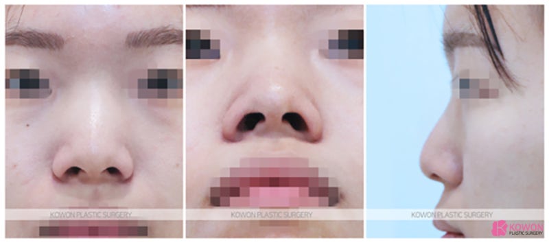 복코수술전후 콧등성형 비교 인상 이목구비 형태 사진 2
