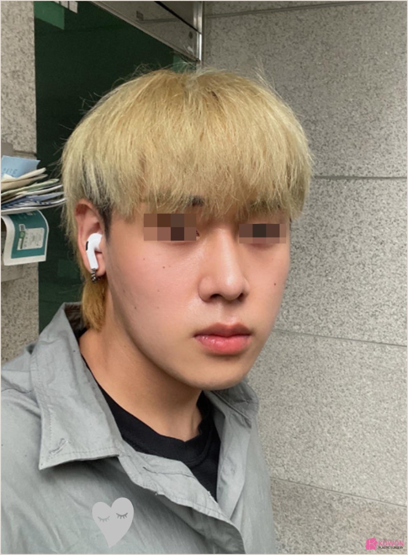 청담성형외과 남성 첫코성형 비염 수술 후기 사진 12