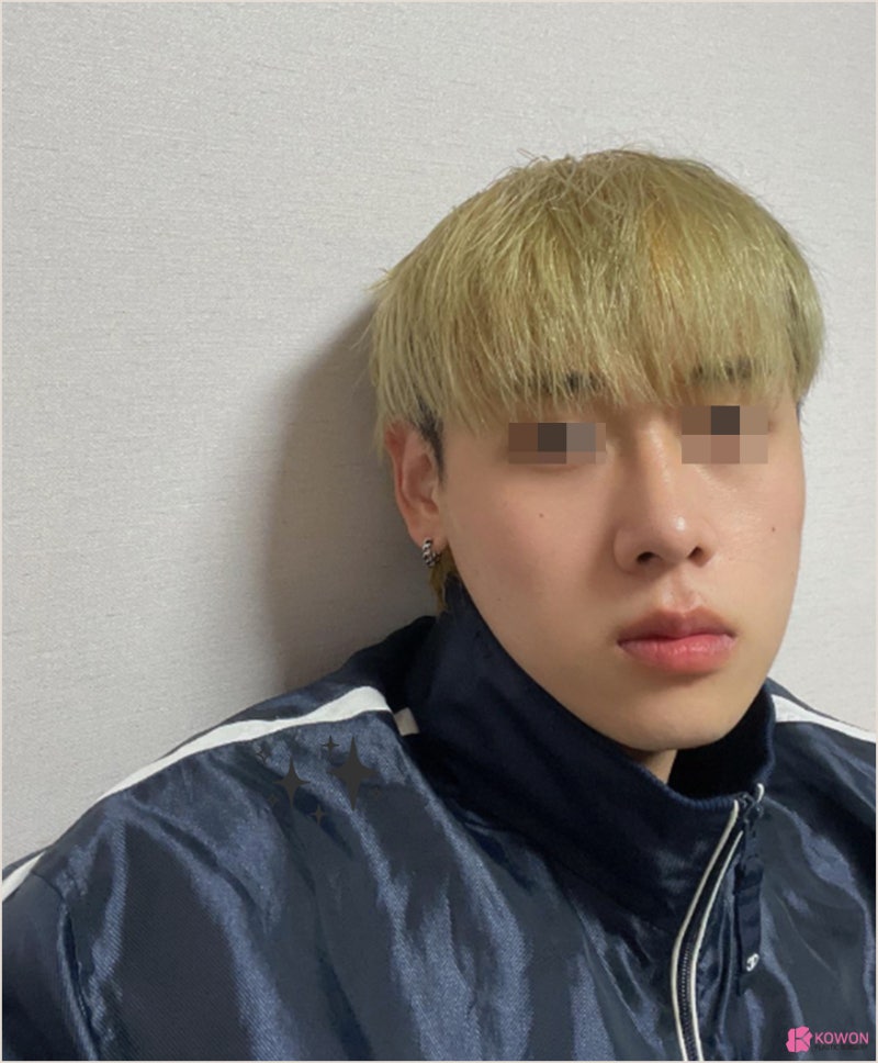 청담성형외과 남성 첫코성형 비염 수술 후기 사진 13