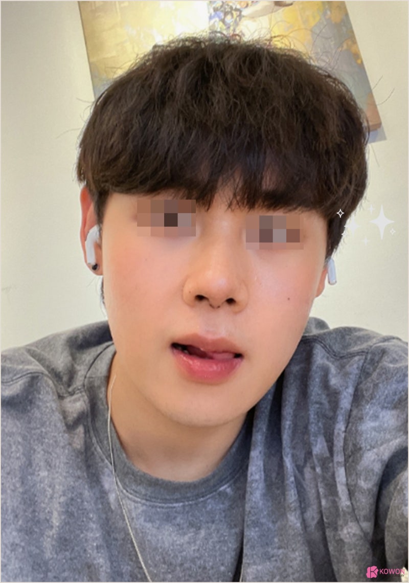 청담성형외과 남성 첫코성형 비염 수술 후기 사진 5