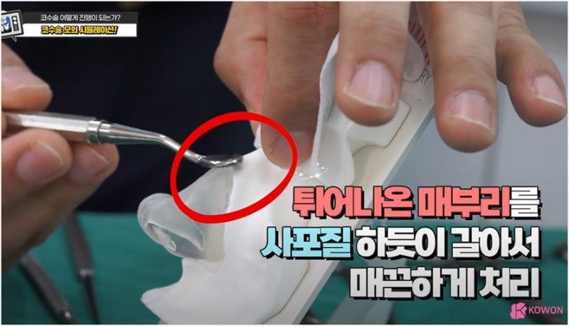 성형외과수술실 설명 매부리코수술방법 시뮬레이션 사진 3