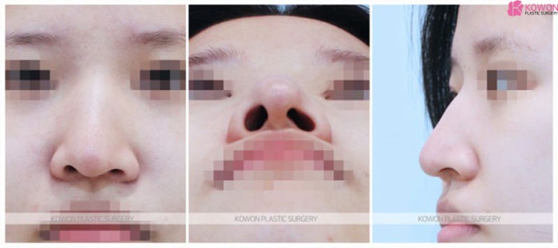 여자매부리코 콧구멍 비대칭 교정 신사동성형외과