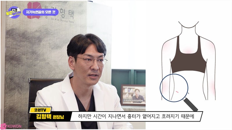 강남유명한성형외과 연골코성형 재료 종류 특징 사진 9