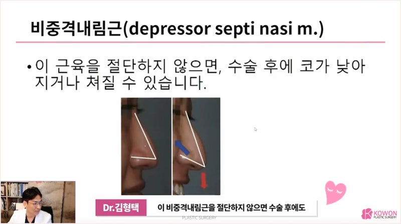 화살코수술 비중격 교정 방법 코성형외과추천 사진 9