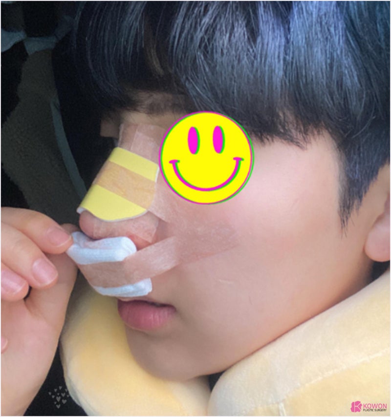 신논현성형외과추천 코끝내리기 재수술 사례 유의사항 사진 5
