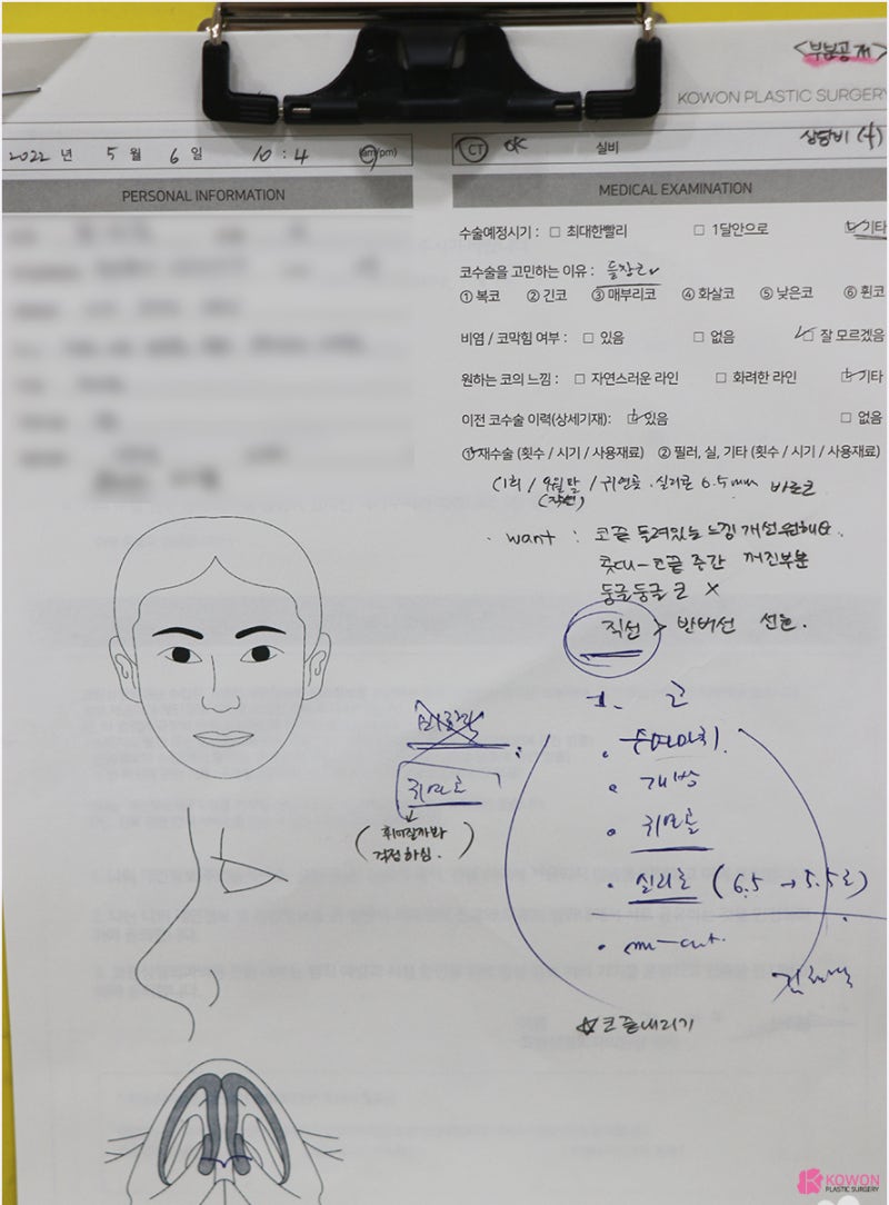 신논현성형외과추천 코끝내리기 재수술 사례 유의사항
