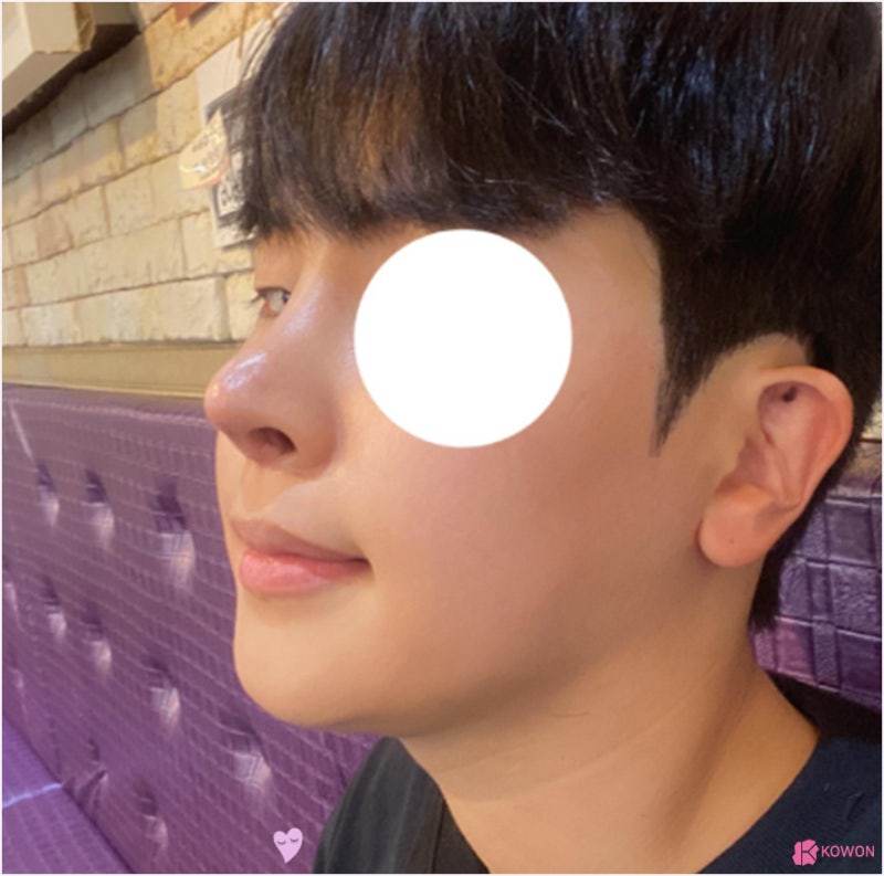 신논현성형외과추천 코끝내리기 재수술 사례 유의사항 사진 13