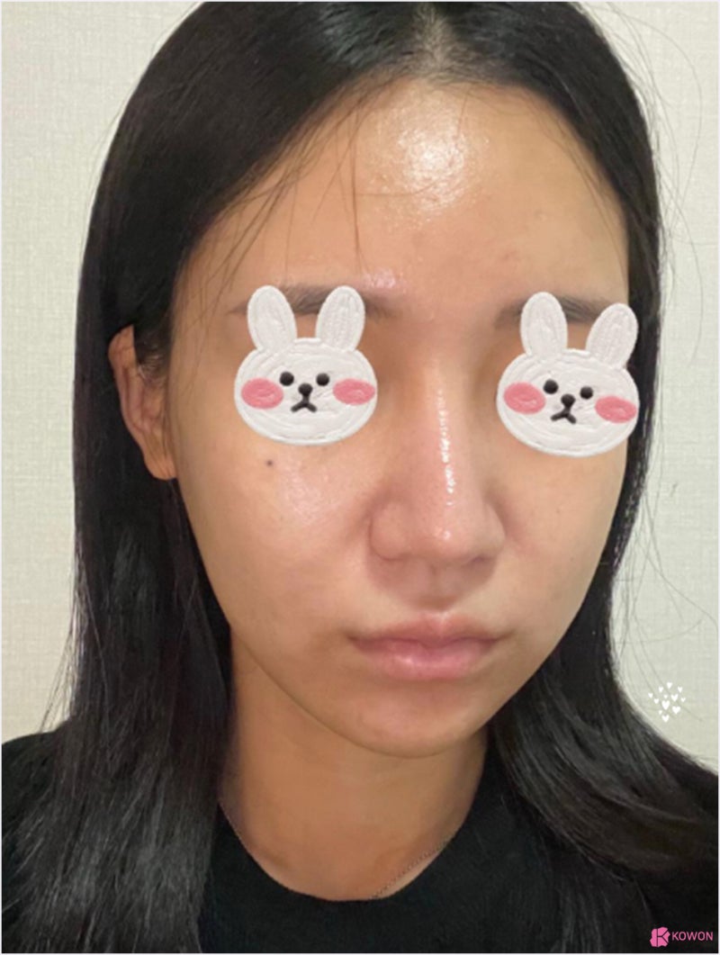 압구정코성형외과 세파 알레르기 비순각 화살코성형후기 사진 3