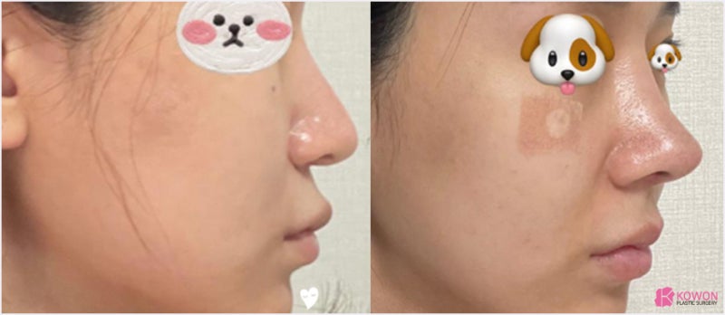 압구정코성형외과 세파 알레르기 비순각 화살코성형후기 사진 10