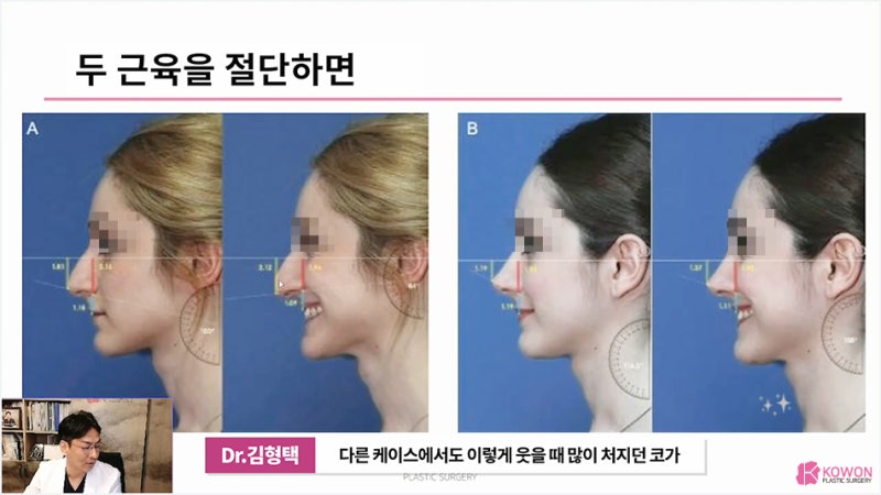 신사역성형외과 긴코수술 화살코 콧날개 교정 수술 사진 7