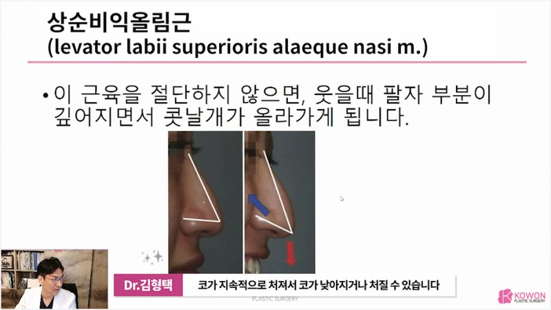 신사역성형외과 긴코수술 화살코 콧날개 교정 수술 사진 6