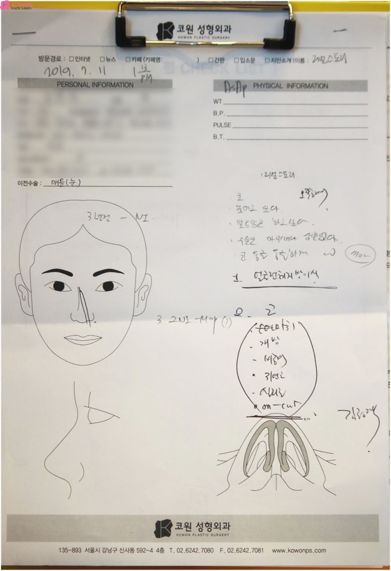 콧대성형 자연스러운 모양 압구정코수술 후기