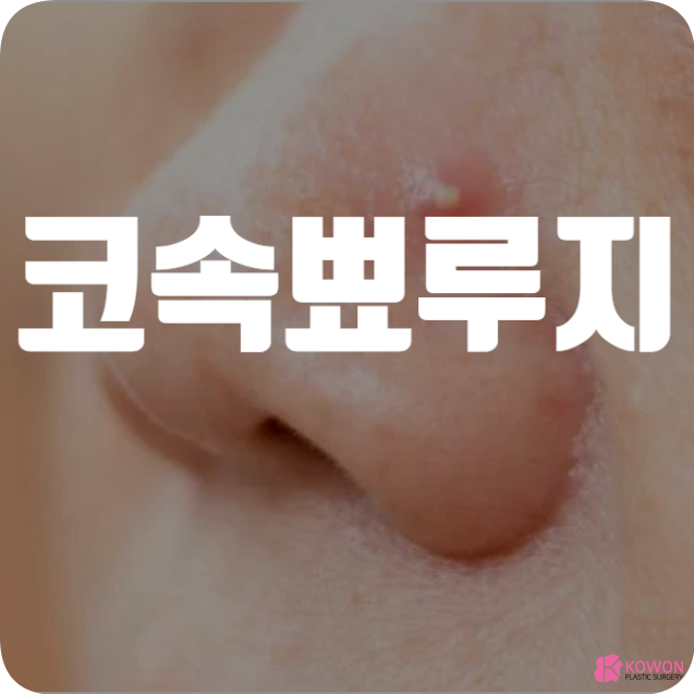 코안 뾰루지 주변 여드름 염증 생기는 이유 제거법
