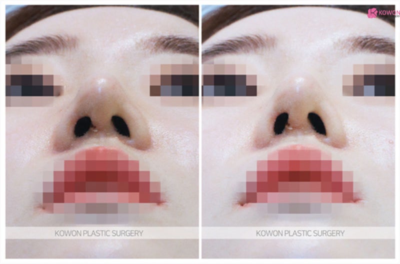 코끝성형수술후기 필러 실 이용한 방법 하이코시술부작용 사진 8