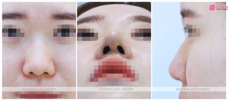코끝성형수술후기 필러 실 이용한 방법 하이코시술부작용 사진 4