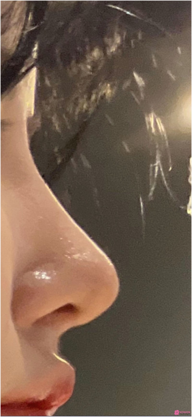 자가늑코수술 매부리복코 교정 화려한 모양 사진 9