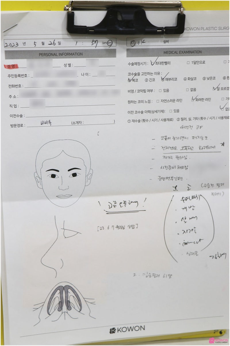 자가늑코수술 매부리복코 교정 화려한 모양