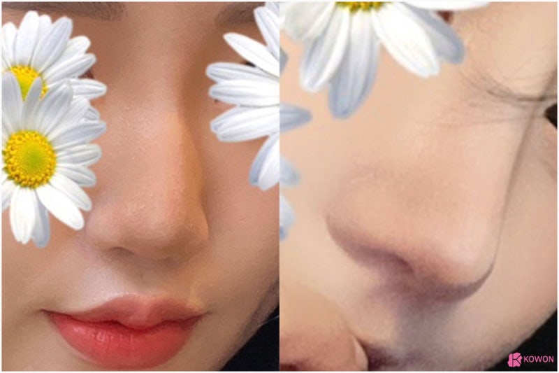 자가늑코수술 매부리복코 교정 화려한 모양