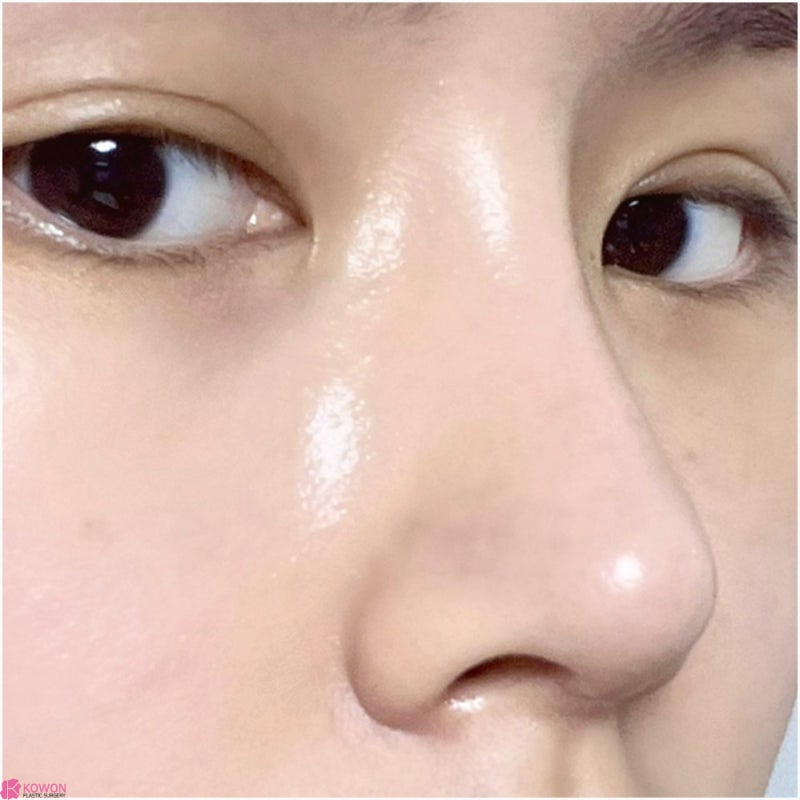 여자코성형후기 코수술부작용병원 연골 튀어나옴 해결