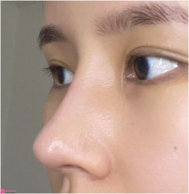 여자코성형후기 코수술부작용병원 연골 튀어나옴 해결 사진 4