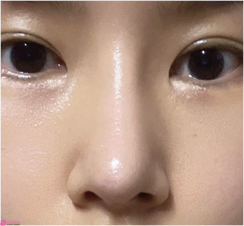 여자코성형후기 코수술부작용병원 연골 튀어나옴 해결