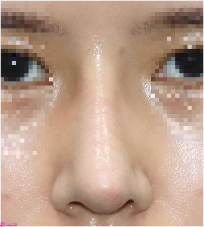여자코성형후기 코수술부작용병원 연골 튀어나옴 해결