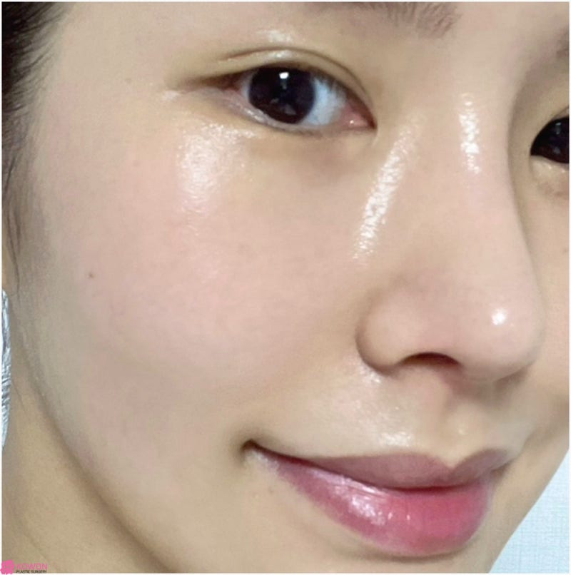 여자코성형후기 코수술부작용병원 연골 튀어나옴 해결 사진 7