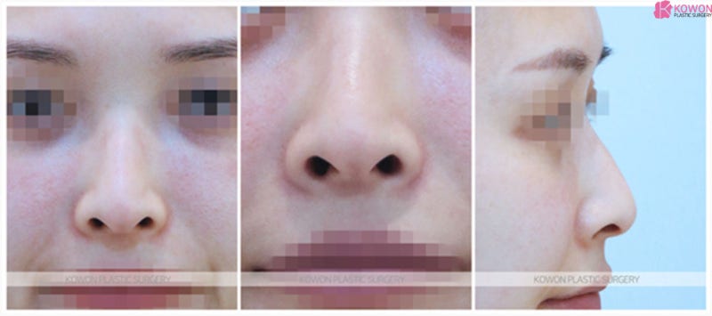 여자매부리코성형수술 측면 모습 옆모습미인 되는 방법