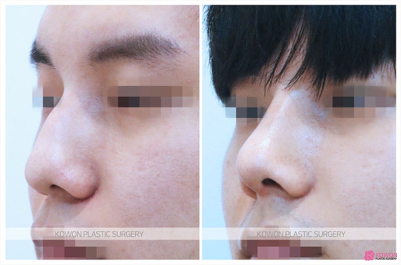 비중격만곡증후기 심한매부리 비염 기능 문제