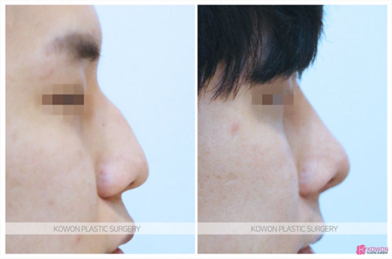 비중격만곡증후기 심한매부리 비염 기능 문제 사진 6