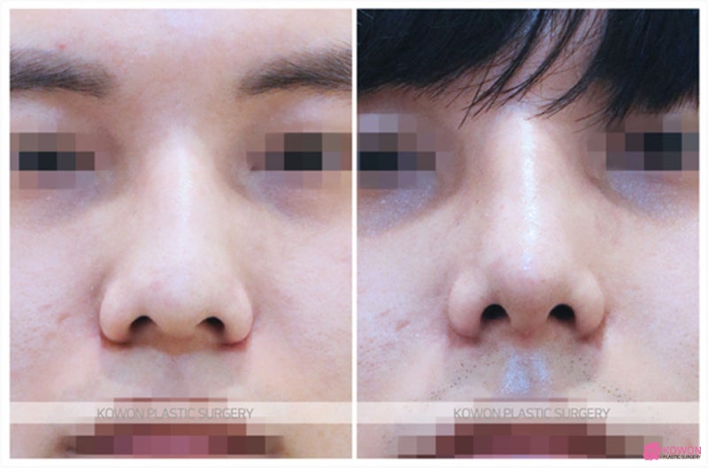 비중격만곡증후기 심한매부리 비염 기능 문제 사진 4