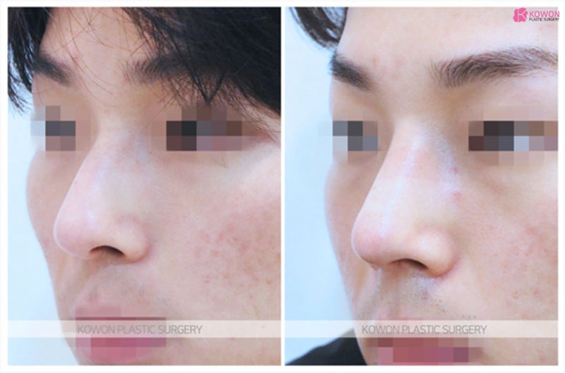 매부리코성형수술 기능 문제 개선과 옆모습미남 변화 사진 5