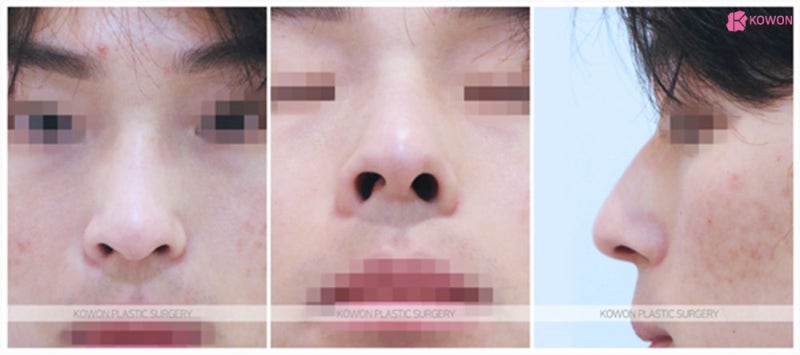 매부리코성형수술 기능 문제 개선과 옆모습미남 변화