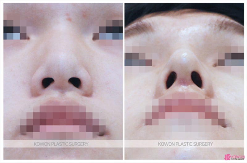 남자매부리코 교정한 절골술 콧대높이기 사진 4