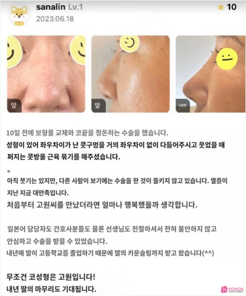 코 보형물교체 코끝정돈 일본인 수술후기 사례