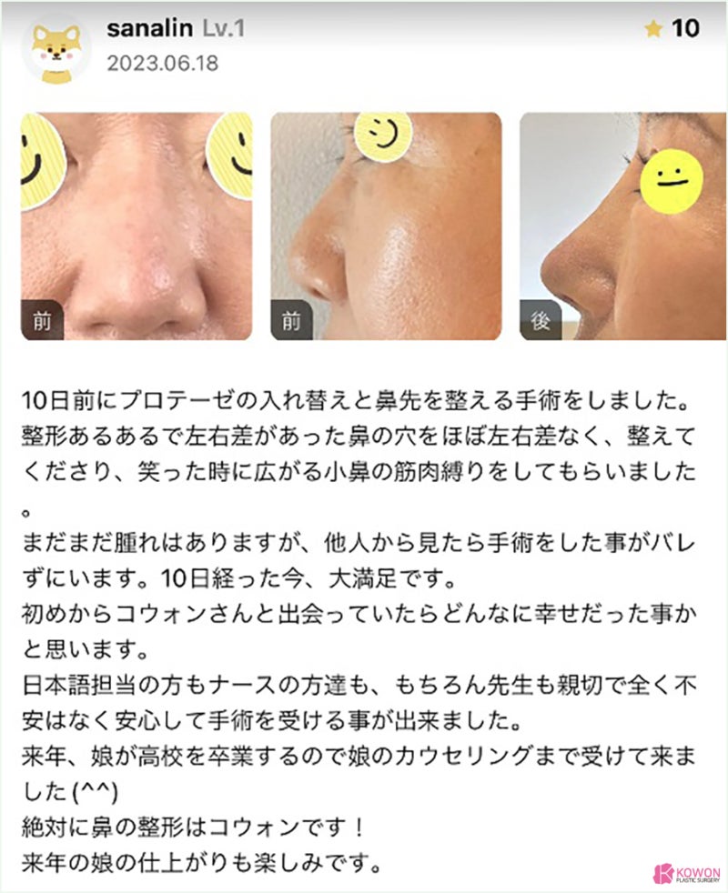 코 보형물교체 코끝정돈 일본인 수술후기 사례