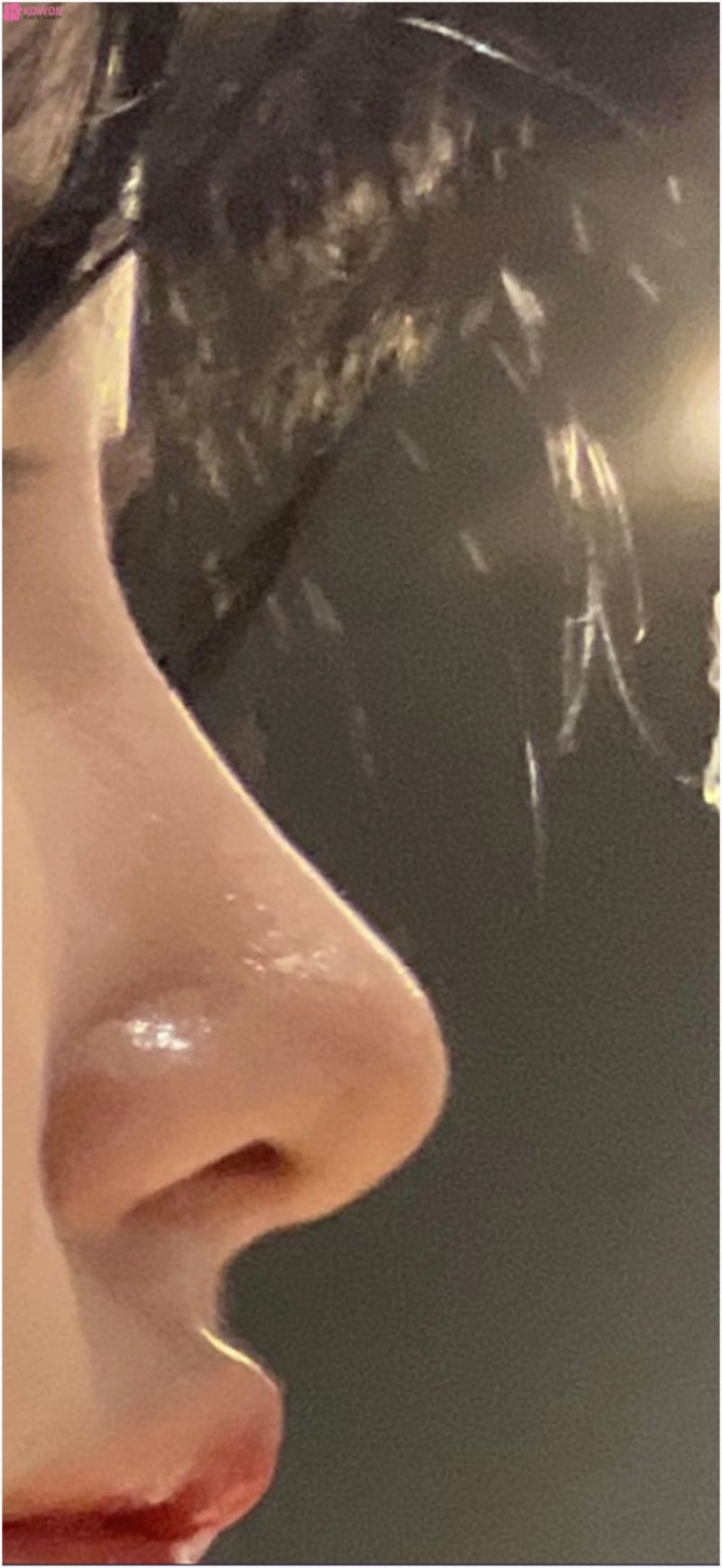 학동역성형외과 뭉툭한 복코 개선 바비톡후기 사진 9