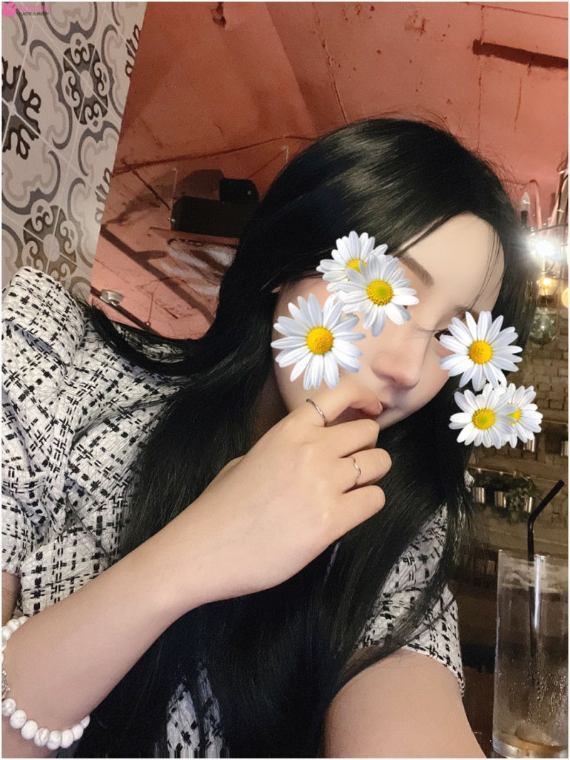 학동역성형외과 뭉툭한 복코 개선 바비톡후기 사진 4