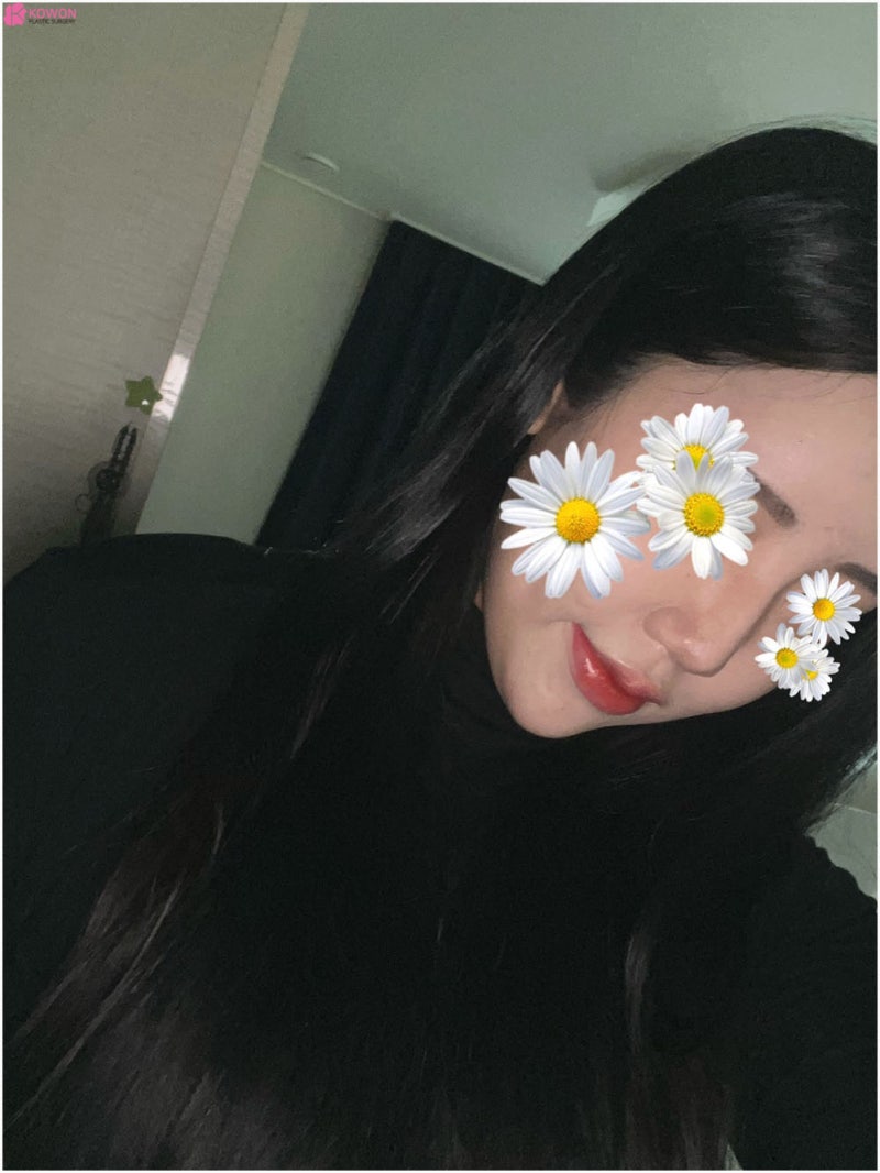 학동역성형외과 뭉툭한 복코 개선 바비톡후기