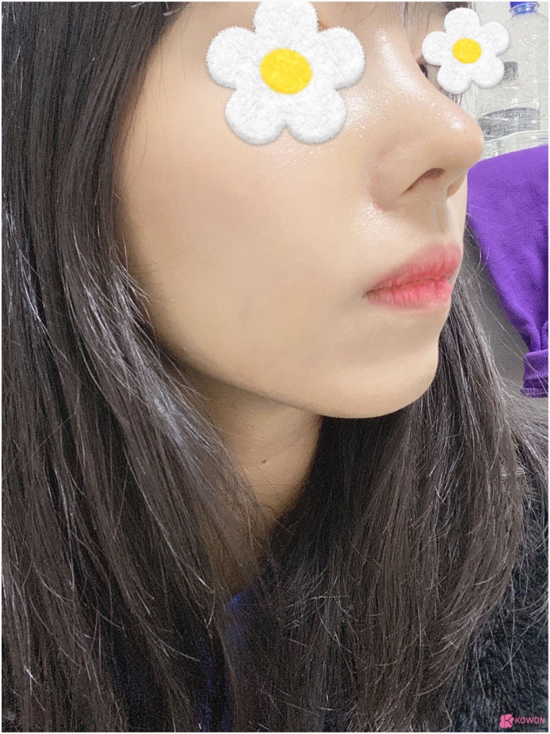 코성형전문성형외과 여자매부리코 콤플렉스 해결 사진 12