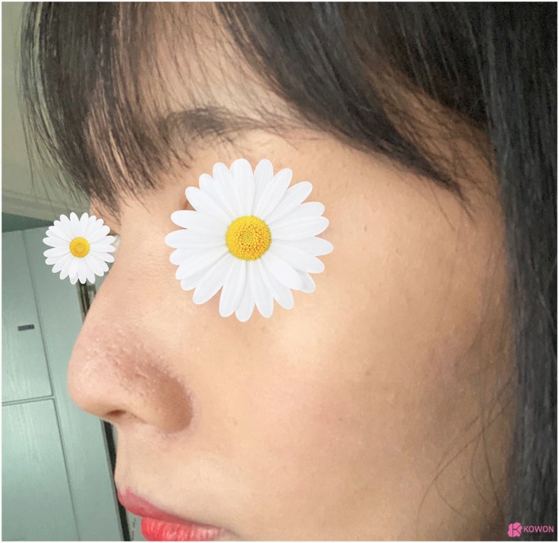 코성형전문성형외과 여자매부리코 콤플렉스 해결 사진 6