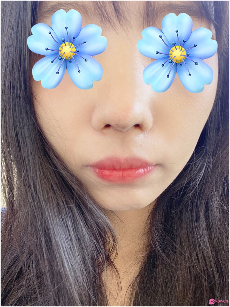 코성형전문성형외과 여자매부리코 콤플렉스 해결 사진 9