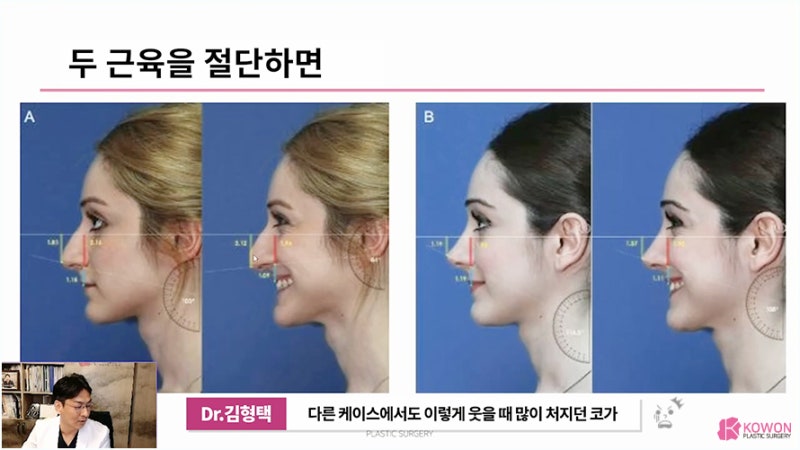 강남구성형외과 웃을때코끝모양 화살코 교정 수술 사진 7