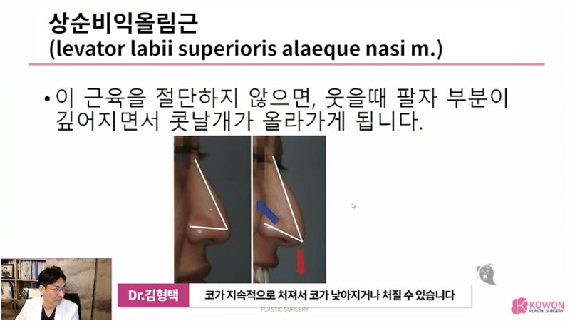 강남구성형외과 웃을때코끝모양 화살코 교정 수술 사진 6