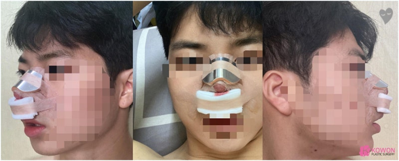 논현동성형외과 남자복코 자가 늑연골 연장 수술 사진 3