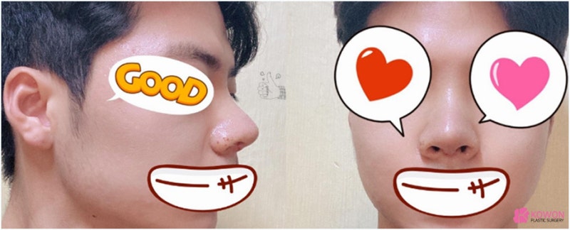 논현동성형외과 남자복코 자가 늑연골 연장 수술 사진 5